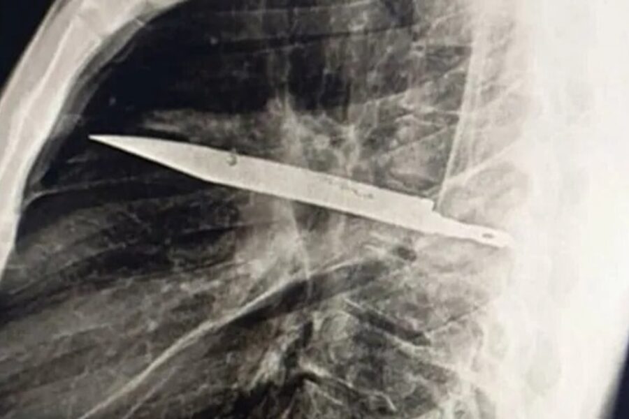 Descubren después de 8 años que una persona tenía un cuchillo completo incrustado en su pecho