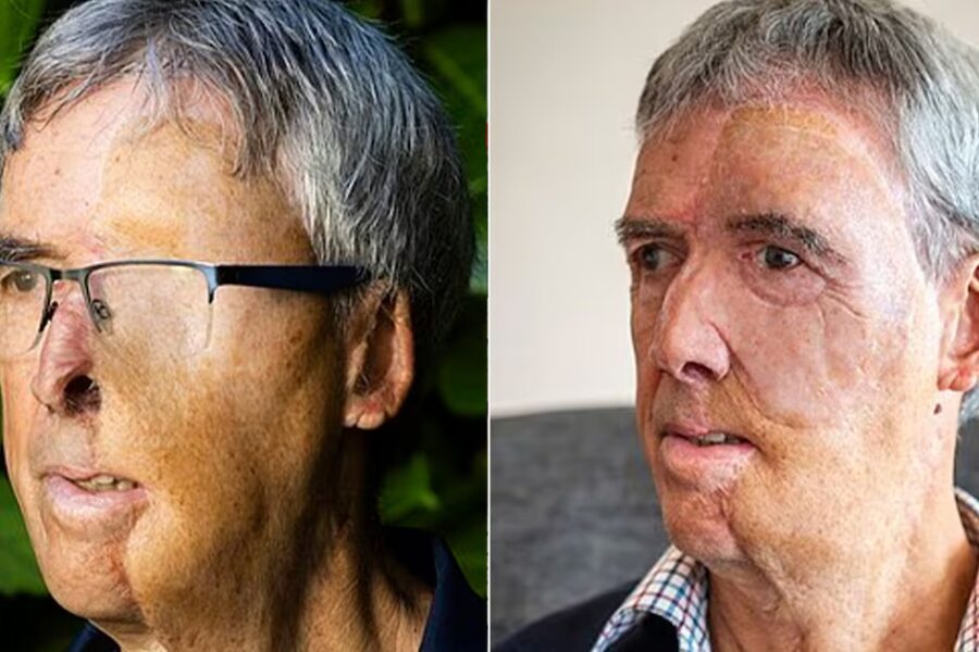 Política sanitaria: la prótesis 3D que devolvió el rostro a un hombre desfigurado tras perder un ojo