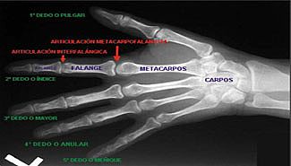 Los rayos X no detectan todas las fracturas