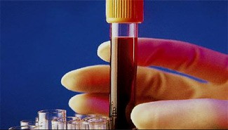 Donar sangre puede evitar la aparición de diabetes tipo 2