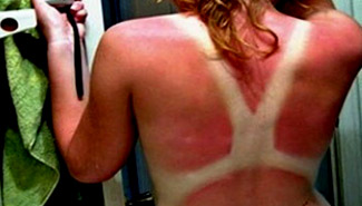 Aumentaron los casos de cáncer de piel por los malos hábitos de bronceado