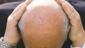 Crean fármaco para eliminar la calvicie pero apareja problemas sexuales